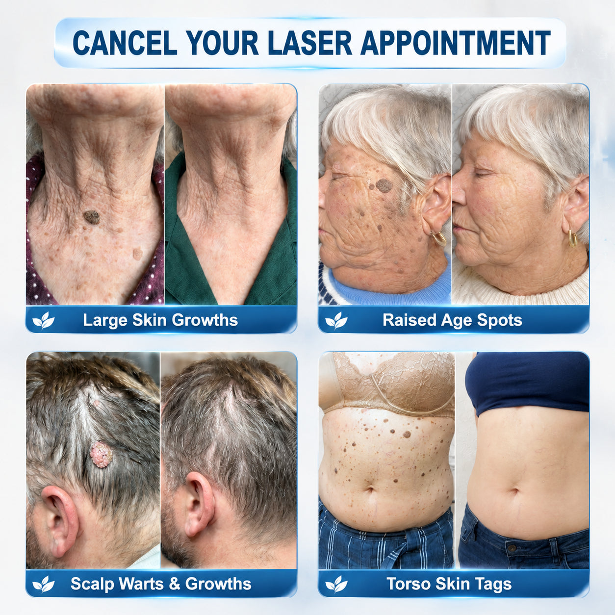 Limited-Time Offer 🎁Congratulations! You are the 269th customer to place an order today! 🎁  Click now to receive 40% OFF your next purchase of 𝐏i𝐜𝐝𝐨® 7-Day Tag & Spot Eraser (Zero Pain, Zero Scars Rollerball Design) 🛒