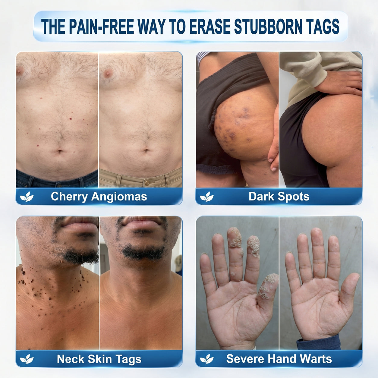 Limited-Time Offer 🎁Congratulations! You are the 269th customer to place an order today! 🎁  Click now to receive 40% OFF your next purchase of 𝐏i𝐜𝐝𝐨® 7-Day Tag & Spot Eraser (Zero Pain, Zero Scars Rollerball Design) 🛒