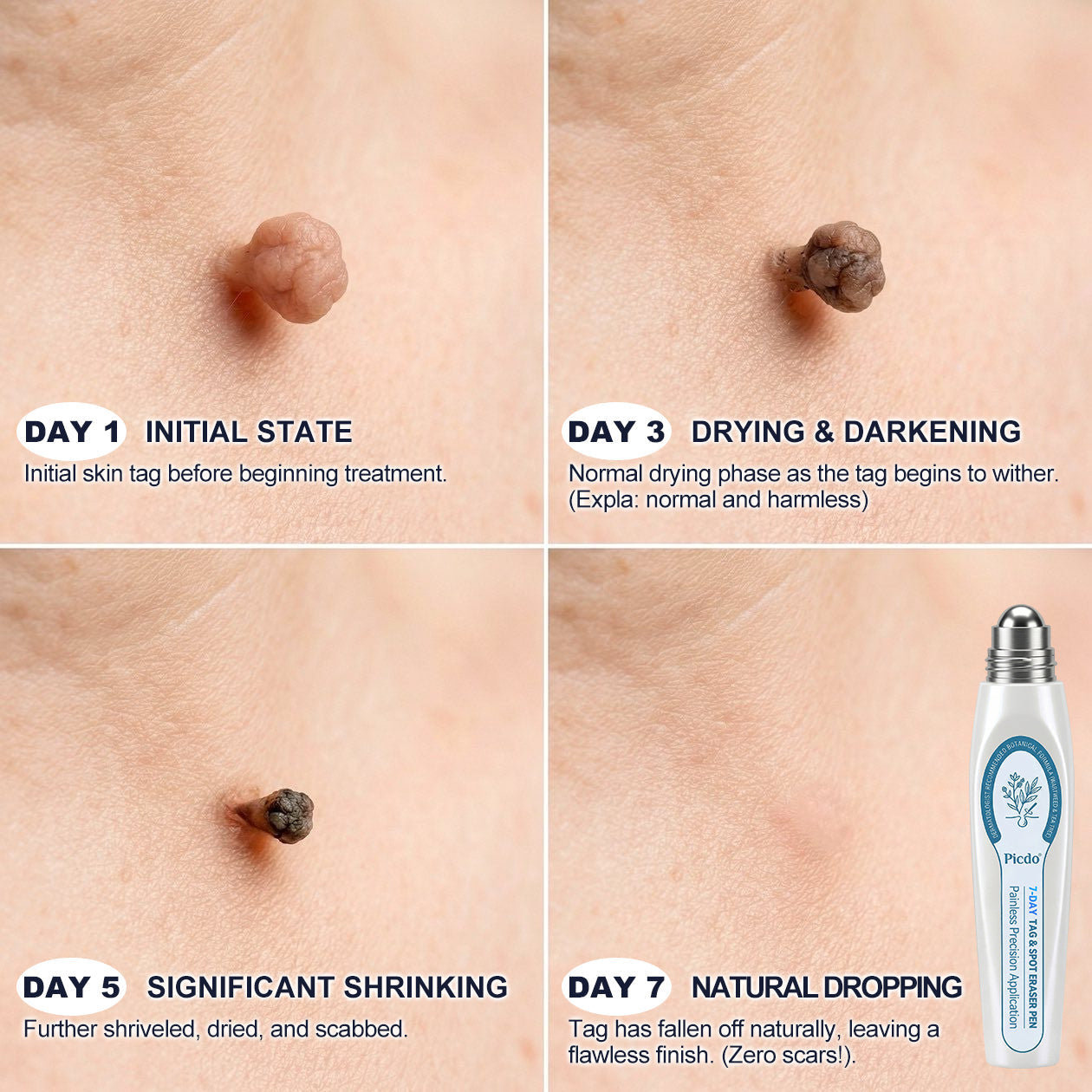 Limited-Time Offer 🎁Congratulations! You are the 269th customer to place an order today! 🎁  Click now to receive 40% OFF your next purchase of 𝐏i𝐜𝐝𝐨® 7-Day Tag & Spot Eraser (Zero Pain, Zero Scars Rollerball Design) 🛒