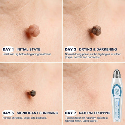 Limited-Time Offer 🎁Congratulations! You are the 269th customer to place an order today! 🎁  Click now to receive 40% OFF your next purchase of 𝐏i𝐜𝐝𝐨® 7-Day Tag & Spot Eraser (Zero Pain, Zero Scars Rollerball Design) 🛒