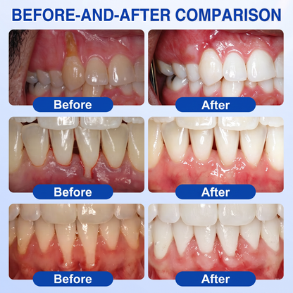 🇮🇪Glimmerly® 🧑‍⚕️💖GumRevive periodontal repair gel